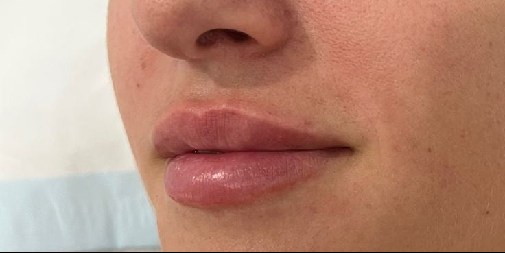 A_little_goes_a_long_way_when_it_comes_to_lip_filler__How_amazing_are_these_subtle_tweaks_for_a_full_yet_natural-looking_pout__Click_the_in_our_bio_to_book_your_lip_filler_appointment.jpg